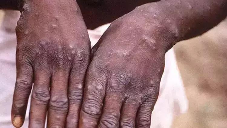 Afrika'da Maymun Çiçeği Varyantı ve Bulaşma Yolları