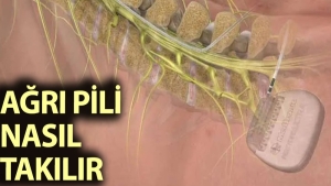 agri-pili-nasil-takilir-NsFPItYz.jpg