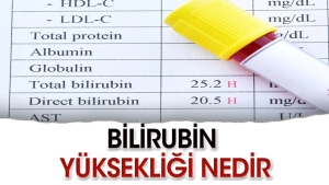 bilirubin-yuksekligi-bedelleri-nasil-duser-YJlNHSGS.jpg