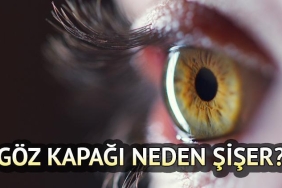 goz-kapagi-sismesi-nedenler-tedavi-yontemleri-ve-evde-uygulanabilir-cozumler-U82yJfaS.jpg