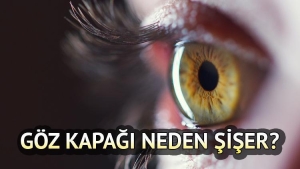 goz-kapagi-sismesi-nedenler-tedavi-yontemleri-ve-evde-uygulanabilir-cozumler-U82yJfaS.jpg