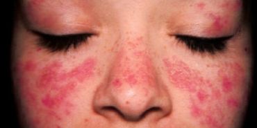 lupus-kelebek-hastaligi-nedir-belirtileri-nelerdir-lupus-hastaligi-tedavisi-var-mi-cFDPgdDq.jpg