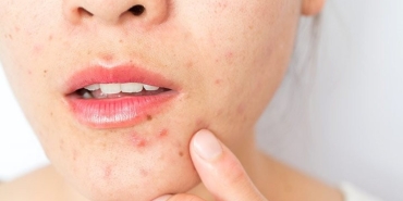 maske-aknesi-maskne-nedir-neden-olur-maskne-nasil-onlenir-FuZsJXhz.jpg