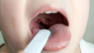 olumcul-bogaz-enfeksiyonu-strep-a-bakterisi-nedir-nasil-bulasir-strep-a-belirtileri-vHeaN1FO.jpg