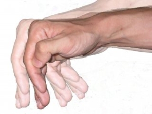 parkinson-hastaligi-nedir-BKlvyQHj.jpg
