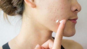 roaccutane-nedir-sivilceler-icin-roaccutane-nasil-kullanilir-roaccutane-yan-etkileri-nelerdir-KXlpRR62.jpg