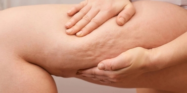 selulit-gibi-gorunen-lipodem-nedir-nasil-anlasilir-pylWrjbX.jpg