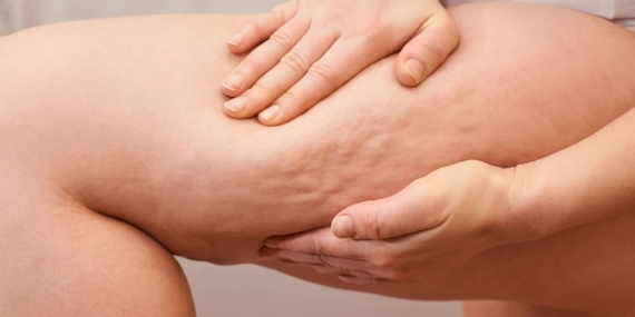 selulit-gibi-gorunen-lipodem-nedir-nasil-anlasilir-pylWrjbX.jpg