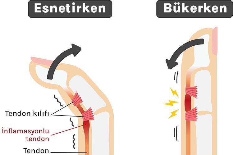 Tetik Parmak: Belirtileri, Nedenleri ve Tedavi Yöntemleri