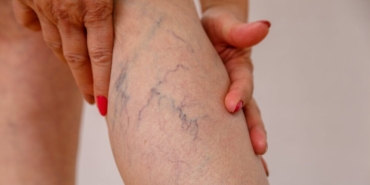 varis-nedir-neden-olusur-bacaklardaki-varislere-ne-iyi-gelir-mCLG9RjI.jpg