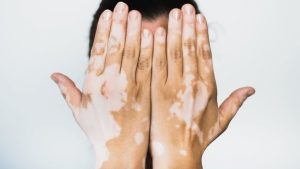 vitiligo-nedir-belirtileri-nelerdir-vitiligo-tedavi-edilir-mi-bulasici-midir-2ix3pBuV.jpg