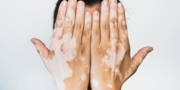 vitiligo-nedir-belirtileri-nelerdir-vitiligo-tedavi-edilir-mi-bulasici-midir-2ix3pBuV.jpg